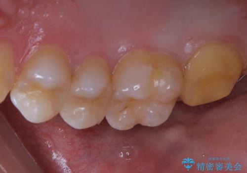 広範囲にわたる虫歯をセラミックで治療の治療中