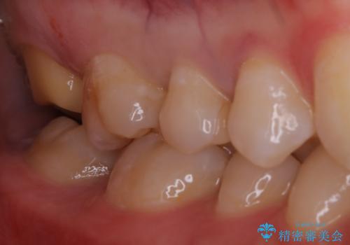 広範囲にわたる虫歯をセラミックで治療の治療中