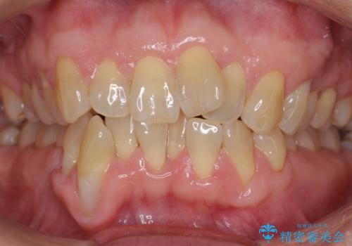 前歯のがたつき　インビザラインで抜歯矯正の症例 治療前