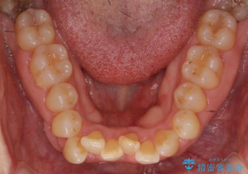 前歯のがたつき インビザラインで抜歯矯正の治療前