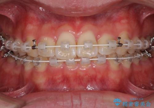 深い咬み合わせとデコボコ ワイヤー矯正で短期治療の治療中