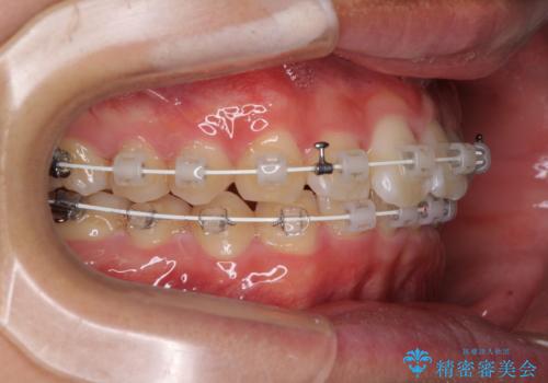 深い咬み合わせとデコボコ ワイヤー矯正で短期治療の治療中