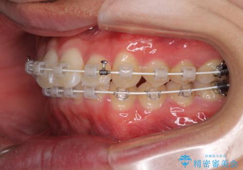 深い咬み合わせとデコボコ ワイヤー矯正で短期治療の治療中