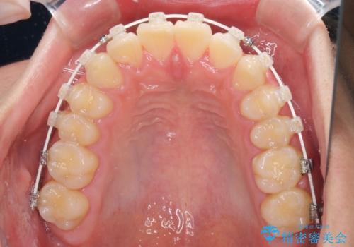深い咬み合わせとデコボコ ワイヤー矯正で短期治療の治療中