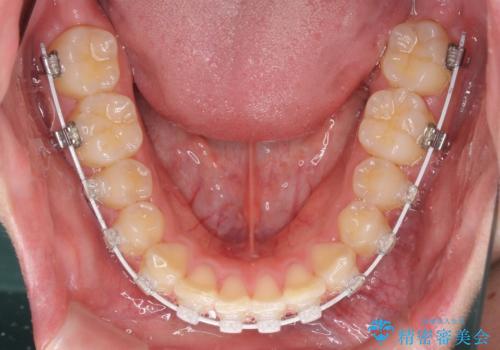 深い咬み合わせとデコボコ ワイヤー矯正で短期治療の治療中