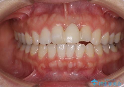 前歯のブリッジが気に入らない　歯肉移植術を併用した前歯のブリッジの治療前