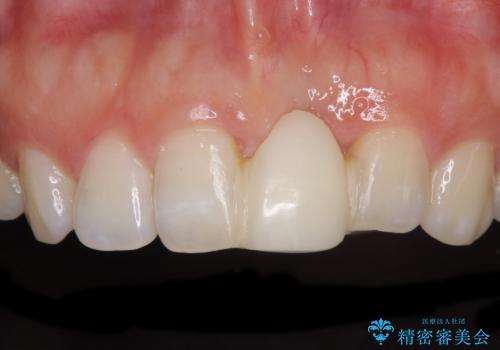 前歯のブリッジが気に入らない　歯肉移植術を併用した前歯のブリッジの症例 治療前