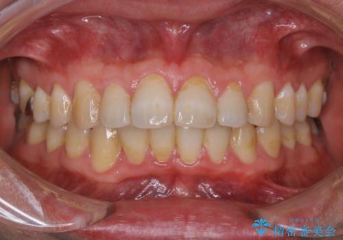 PMTC　歯科衛生士による専門的クリーニングの症例 治療前