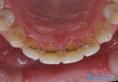 PMTC　歯科衛生士による専門的クリーニングの治療前