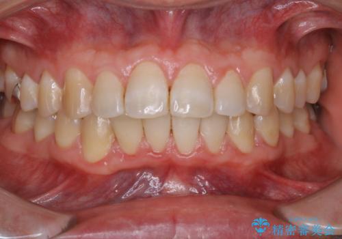 PMTC　歯科衛生士による専門的クリーニングの症例 治療後