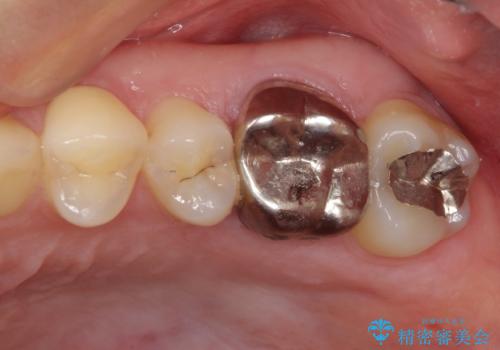 目立つ銀歯を治したい 奥歯のむし歯治療の症例 治療前