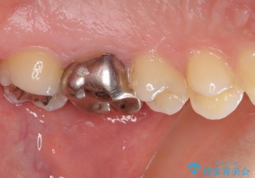 目立つ銀歯を治したい 奥歯のむし歯治療の治療前