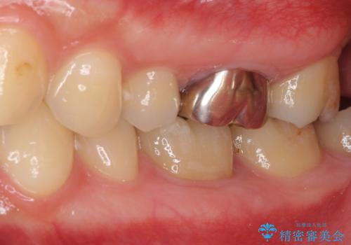 目立つ銀歯を治したい 奥歯のむし歯治療の治療前