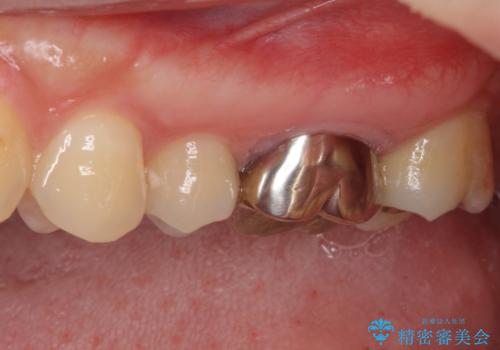目立つ銀歯を治したい 奥歯のむし歯治療の治療前