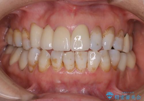 コーヒーによる着色をpmtcできれいにの治療前