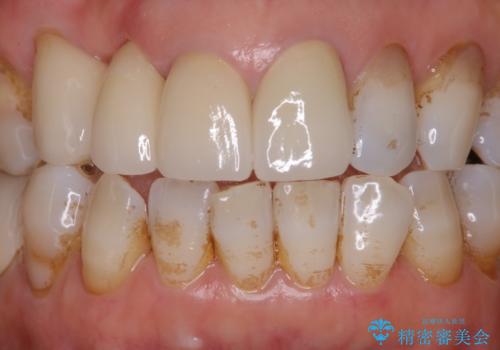 コーヒーによる着色をpmtcできれいにの治療前