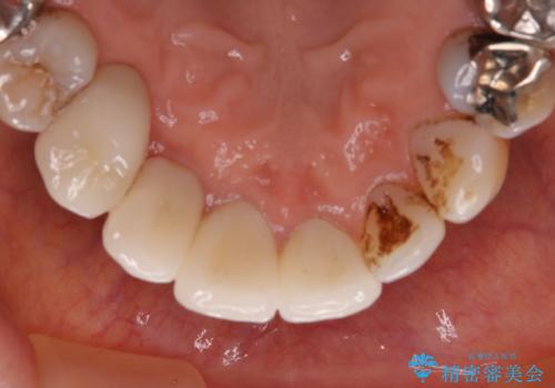 コーヒーによる着色をpmtcできれいにの治療前