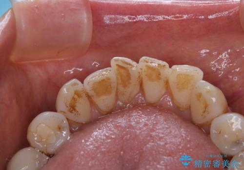 コーヒーによる着色をpmtcできれいにの治療前