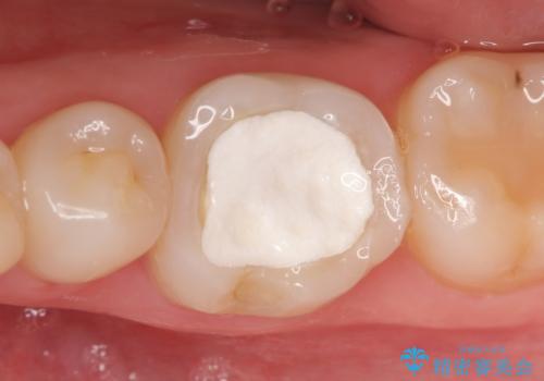 オールセラミッククラウン 他院にて抜歯を提案された歯の治療の治療前