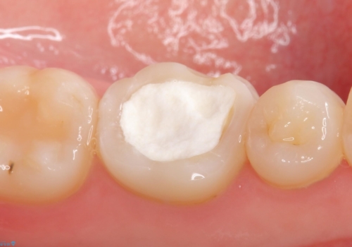 オールセラミッククラウン 他院にて抜歯を提案された歯の治療の治療前
