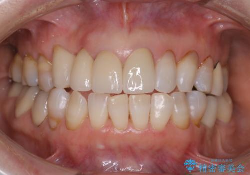 コーヒーによる着色をpmtcできれいにの治療後