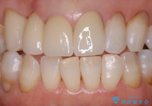 コーヒーによる着色をpmtcできれいにの治療後