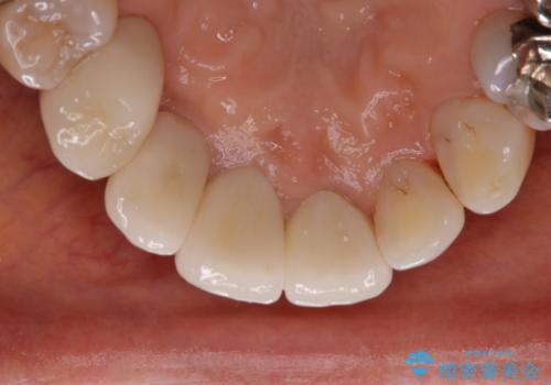 コーヒーによる着色をpmtcできれいにの治療後