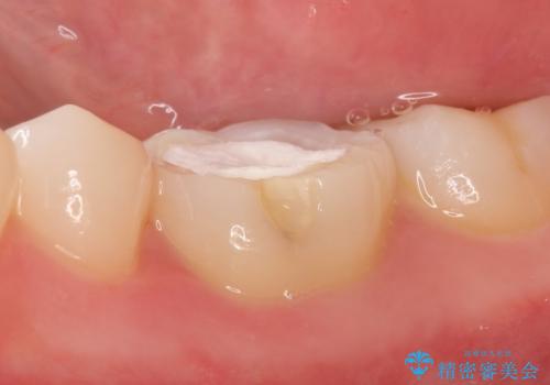 オールセラミッククラウン 他院にて抜歯を提案された歯の治療の治療前