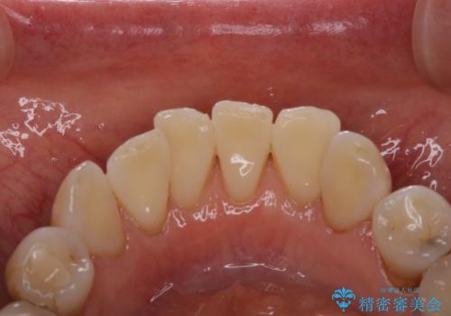 コーヒーによる着色をpmtcできれいにの治療後