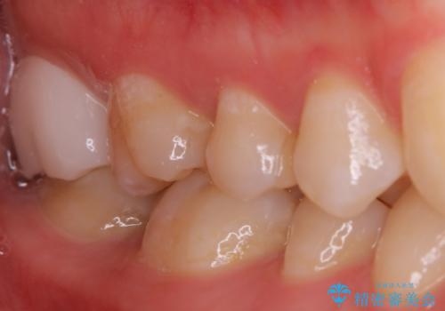 広範囲にわたる虫歯をセラミックで治療の症例 治療後