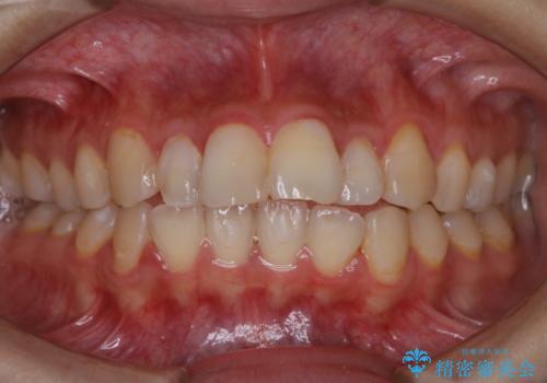 結婚式前の歯のクリーニング　PMTCの症例 治療前