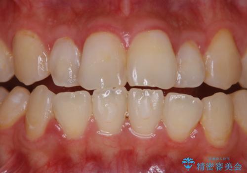 結婚式前の歯のクリーニング PMTCの治療前