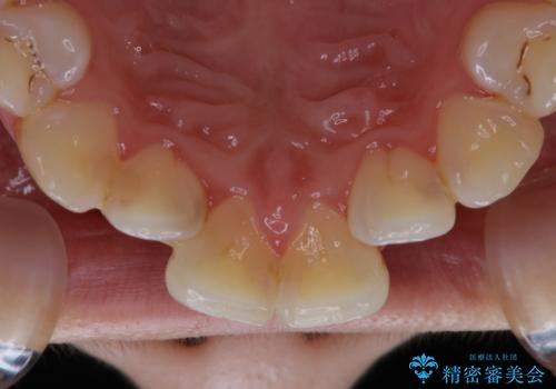 結婚式前の歯のクリーニング PMTCの治療前
