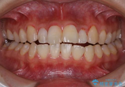 結婚式前の歯のクリーニング　PMTCの症例 治療後