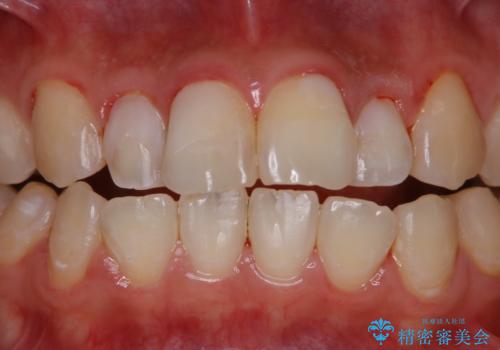 結婚式前の歯のクリーニング PMTCの治療後