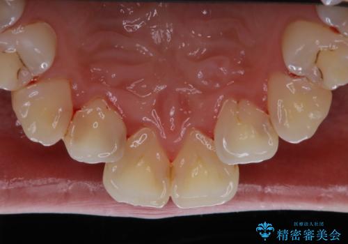 結婚式前の歯のクリーニング PMTCの治療後