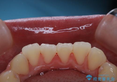 結婚式前の歯のクリーニング PMTCの治療後