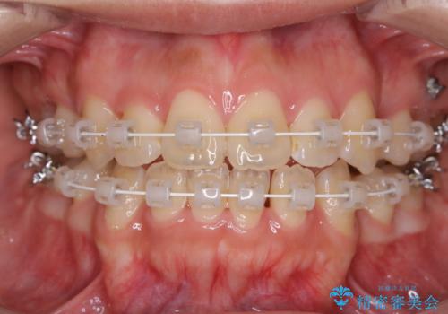 ワイヤー矯正中のクリーニング