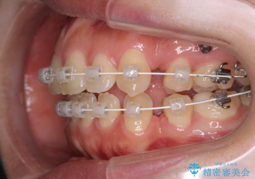 ワイヤー矯正中のクリーニングの治療前