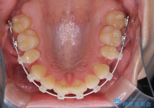ワイヤー矯正中のクリーニングの治療前