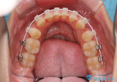 ワイヤー矯正中のクリーニングの治療前
