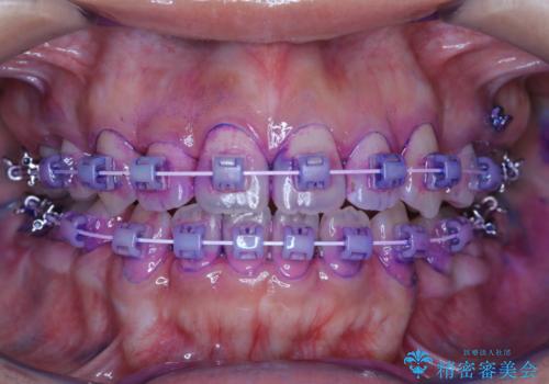 ワイヤー矯正中のクリーニングの治療中