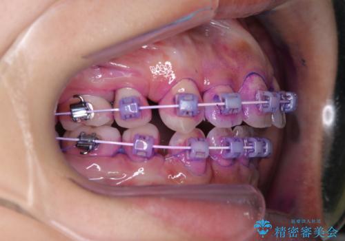 ワイヤー矯正中のクリーニングの治療中