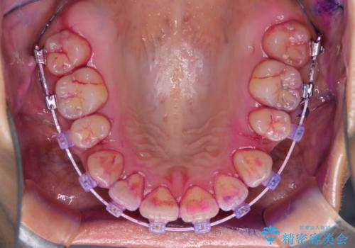 ワイヤー矯正中のクリーニングの治療中