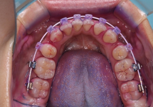 ワイヤー矯正中のクリーニングの治療中