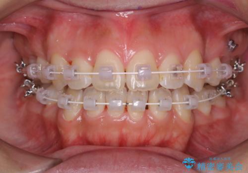 ワイヤー矯正中のクリーニングの症例 治療後