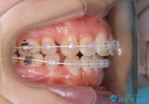 ワイヤー矯正中のクリーニングの治療後