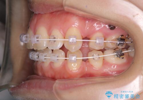 ワイヤー矯正中のクリーニングの治療後