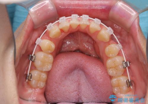ワイヤー矯正中のクリーニングの治療後