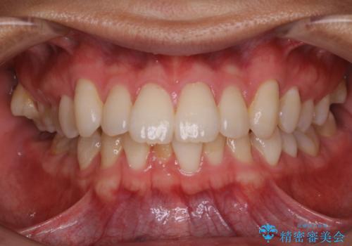 PMTC 歯のお掃除の症例 治療前